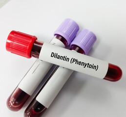 Blood sample for Phenytoin test, therapeutic drug, to maintain a therapeutic level and diagnose...