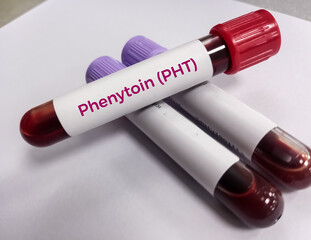 Blood sample for Phenytoin test, therapeutic drug, to maintain a therapeutic level and diagnose...