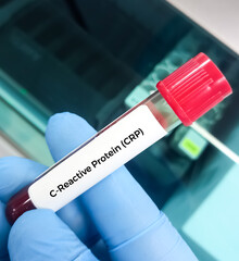 Blood sample for CRP(C-reactive protein) test used to identify inflammation or infection in the...