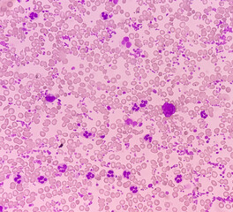 Essential thrombocytosis blood smear showing abnormal high volume of platelet and White Blood Cells. Panmyelosis. Myeloprokiferative disorder.