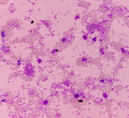Essential thrombocytosis blood smear showing abnormal high volume of platelet and White Blood Cells. Panmyelosis. Myeloprokiferative disorder.