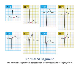 The normal ST segment can be located on the isoelectric line or slightly offset, and the J point in the graph and a part of the ST segment are marked with a red curve.