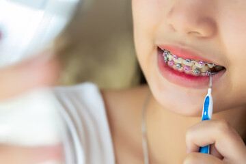 Close up braces teeth, Girl using brush cleaning braces. treatment health and cleaning teeth and...