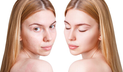 Young woman before and after acne treatment and make-up.
