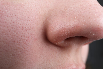 Woman with dry skin on nose, closeup