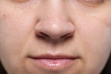 Closeup view of woman with comedones on her nose