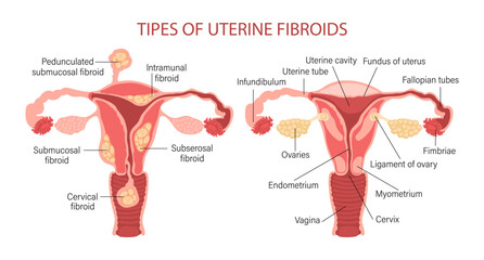 Types of uterine fibroids in women. Fibroids. Diseases of the female reproductive system. Gynecology. Medical concept. Infographic banner. Vector