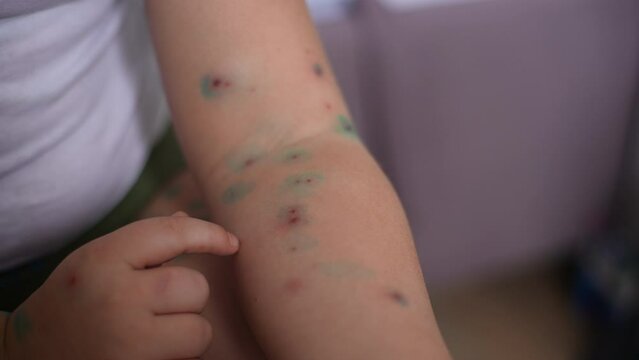 Close-up cropped shot of unrecognizable sick child boy whose arm covered with pimples of chickenpox anointed with green paint. Cute little boy having chicken pox, cured with brilliant green antiseptic