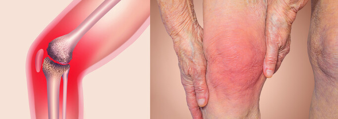 Acute pain in a knee joint, close-up. Color image, isolated on a pastel background. Pain area of red color, Senior woman holding the knee with pain. Collage. - obrazy, fototapety, plakaty