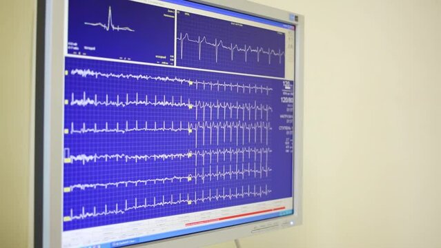 The monitor shows a cardiogram in real time during a stress test
