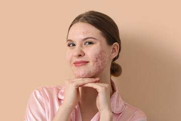 Young woman with acne problem on beige background, closeup