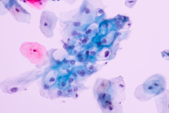 Abnormal squamous epithelial cells view in microscopy.Humanpapilloma virus (HPV) criteria for pap smear slide cytology.Koilocyte cells.Human cell medical concept background.