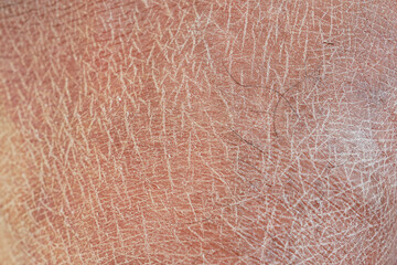 Closeup view of dry human skin .