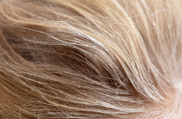 White snowflakes on the blonde's hair. Macro