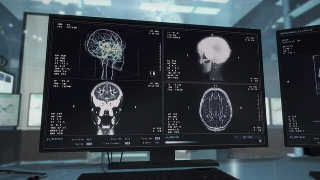 Advanced Brain Scanner In Medical Laboratory Inspects Organ For Disease. Screening Scan Of Brain. Medical Analysis. Scanning Patient Brain. Medical Examination. Healthcare. Diagnosis. Imaging