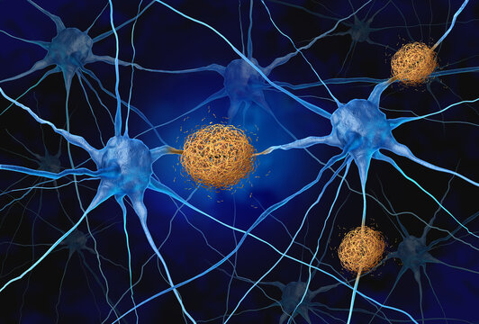 Amyloid Plaques concept as abnormal clusters of protein fragments that accumulate between nerve cells in the brain resulting in degenerative disease as Alzheimers and dementia as  beta-amyloid fragmen
