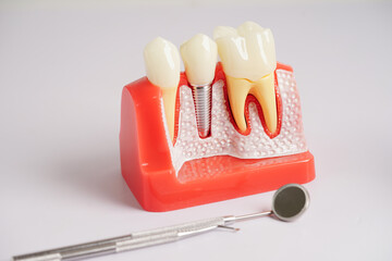 Dental implant, artificial tooth roots into jaw, root canal of dental treatment, gum disease, teeth model for dentist studying about dentistry..