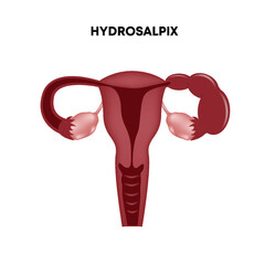 Hydrosalpinx. Female reproductive system. Vector illustration