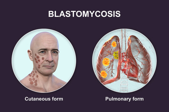Clinical forms of blastomycosis, 3D illustration