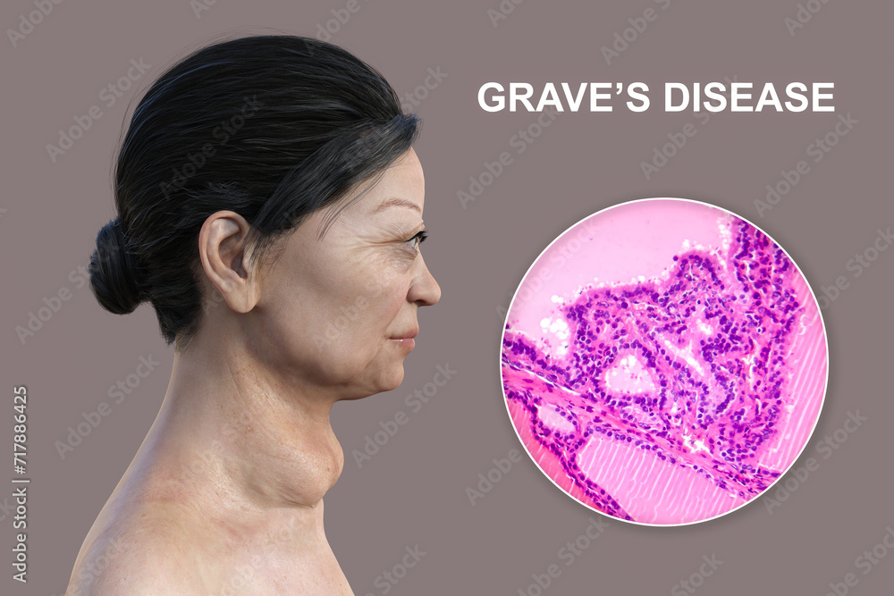 Wall mural toxic goiter, 3d illustration and micrograph