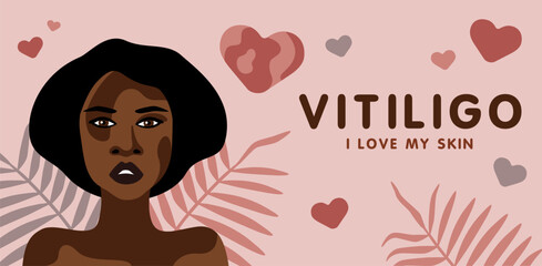 Banner about vitilingo skin disease with young beautiful African American woman minimalistic vector