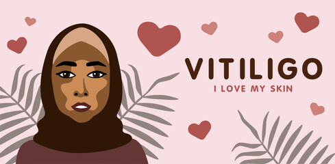 Banner about vitilingo skin disease with young beautiful Muslim woman minimalistic vector