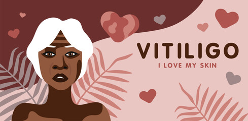 Banner about vitilingo skin disease with elderly African American woman minimalistic vector