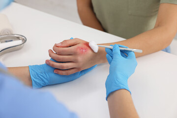 Doctor treating patient's burned hand at table, closeup