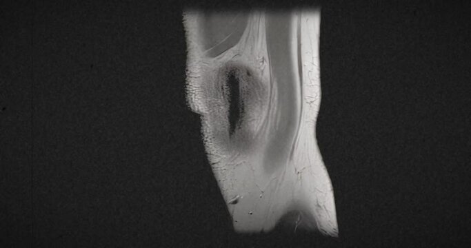 Vintage textured  MRI scan of an injured male knee, after excess basketball playing. Scanning side to side.