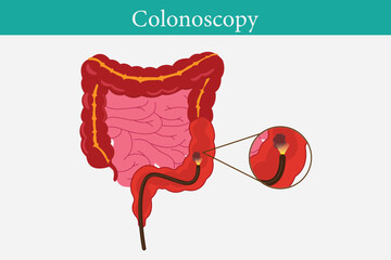 Colonoscopy treatment, familial adenomatous polyposis. Examination and diagnosis of the large intestine. Gastrointestinal disorder anatomical