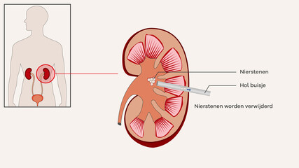 percutane nefrolithotripsie