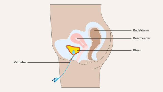 vagina katheter