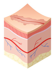 Skincare medical concept. Problems in cross-section of human skin horizontal layers structure. Anatomy illustrative model unhealthy layer of skin