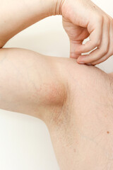 Armpit rash. Unrecognisable man shows irritation on the sensitive skin after using a razor,...