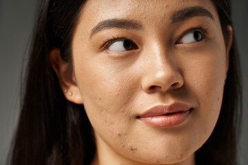 close up shot of young and brunette asian woman with acne prone skin looking away, skin issues