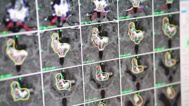Magnetic resonance imaging pictures of brain with tumor on the monitor in the clinic