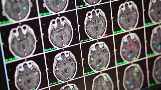 A person looks at pictures of brain scans on the computer monitor