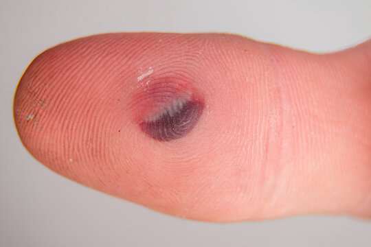Blood blister under the thumb skin. Caucasian young man finger on white background.