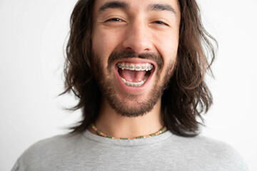 close up of a young adult Latin man's mouth with dental braces laughing and looking into the camera - obrazy, fototapety, plakaty