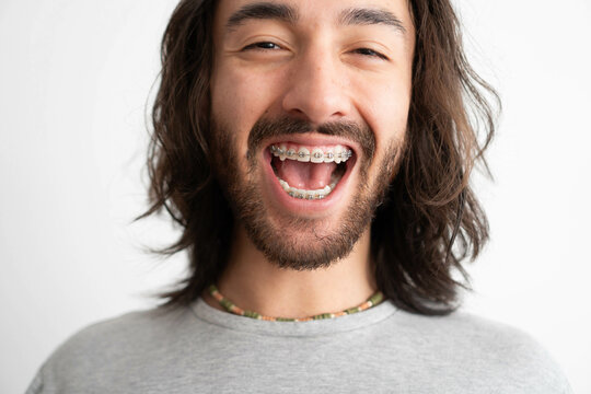 close up of a young adult Latin man's mouth with dental braces laughing and looking into the camera
