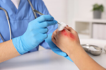 Doctor treating patient's burned hand at table, closeup