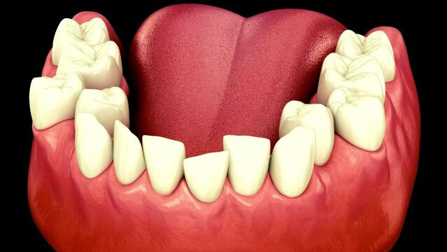 Overcrowding dental occlusion ( Malocclusion of teeth )
