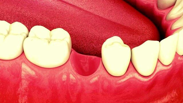 Maryland bridge made from ceramic, front tooth recovery