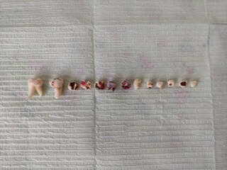 Extracted teeth on a napkin
