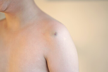 a bruise on Children shoulder, Kid gets hurt from fall Injuries, Medical and Healthcare Concept