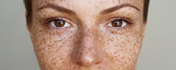 Freckles.Pigmentation. Cropped half face portrait of a young woman grey background. Natural beauty...