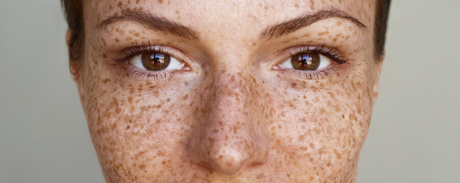 Freckles.Pigmentation. Cropped half face portrait of a young woman grey background. Natural beauty and glowing clean hydrated freckled skin.