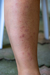 Inflammatory rheumatism. Swollen legs of woman with rheumatoid arthritis.