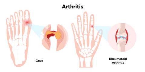 Medical infographic of rheumatoid arthritis hand and foot