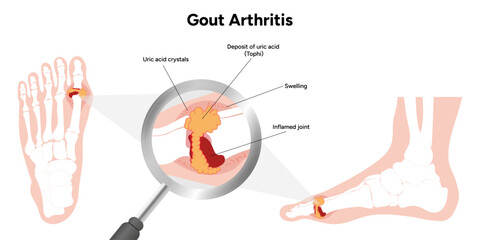 Medical infographic the gout arthritis - obrazy, fototapety, plakaty